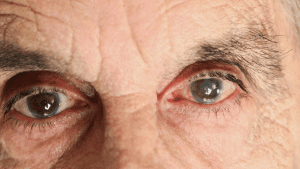 szürkehályog